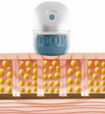 V-ACTOR® - le mode d’action de la thérapie par vibration V-ACTOR® - le mode d’action de la thérapie par vibration